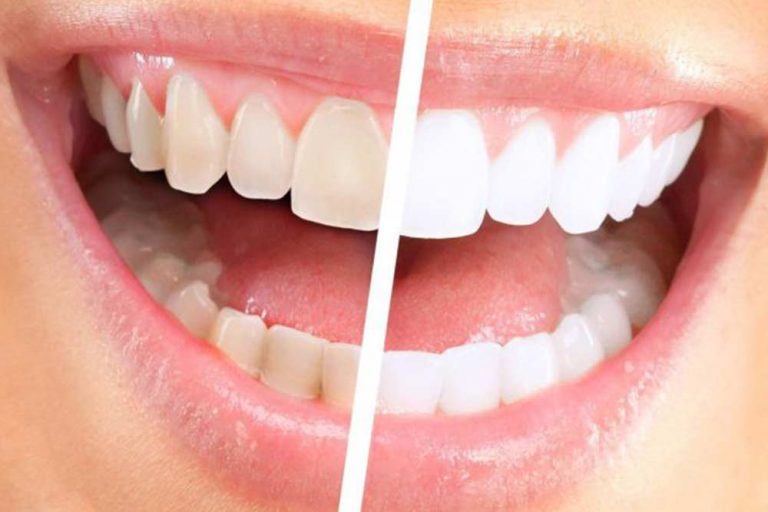 Un bel sorriso comincia da denti bianchissimi